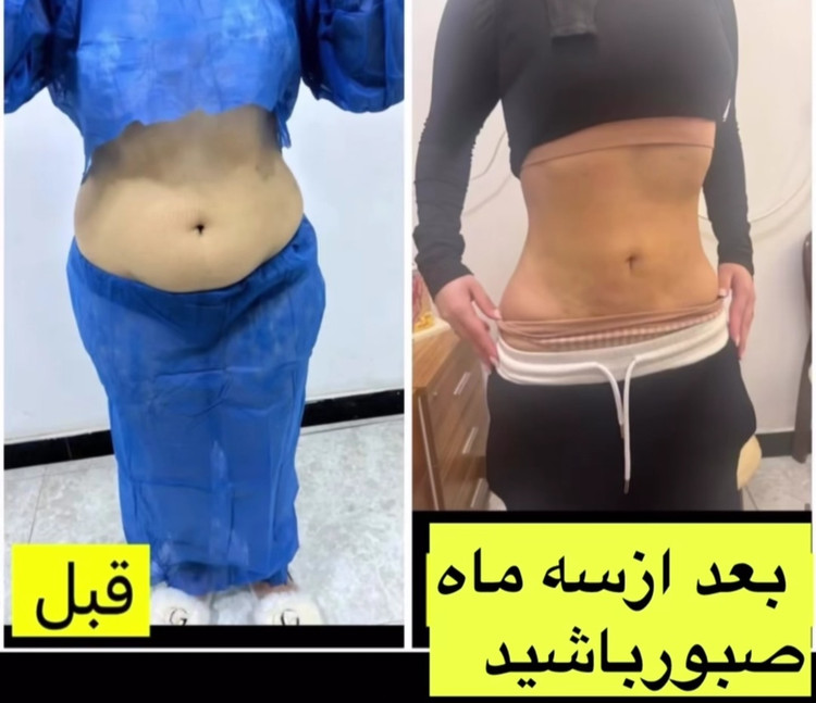 لیپوساکشن شکم